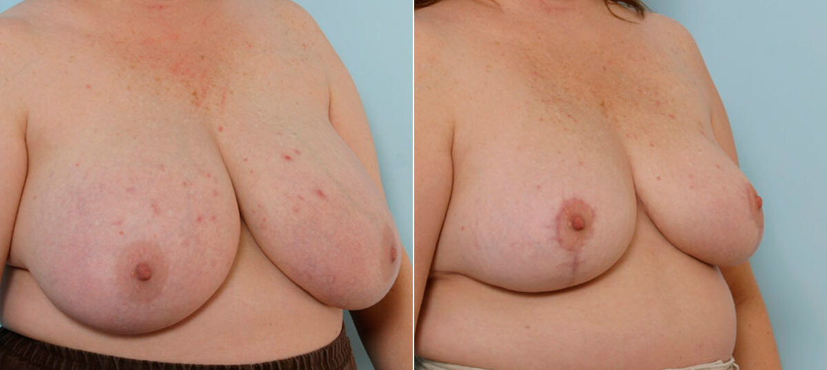 Breast Reduction before and after photos in Houston, TX, Patient 27573
