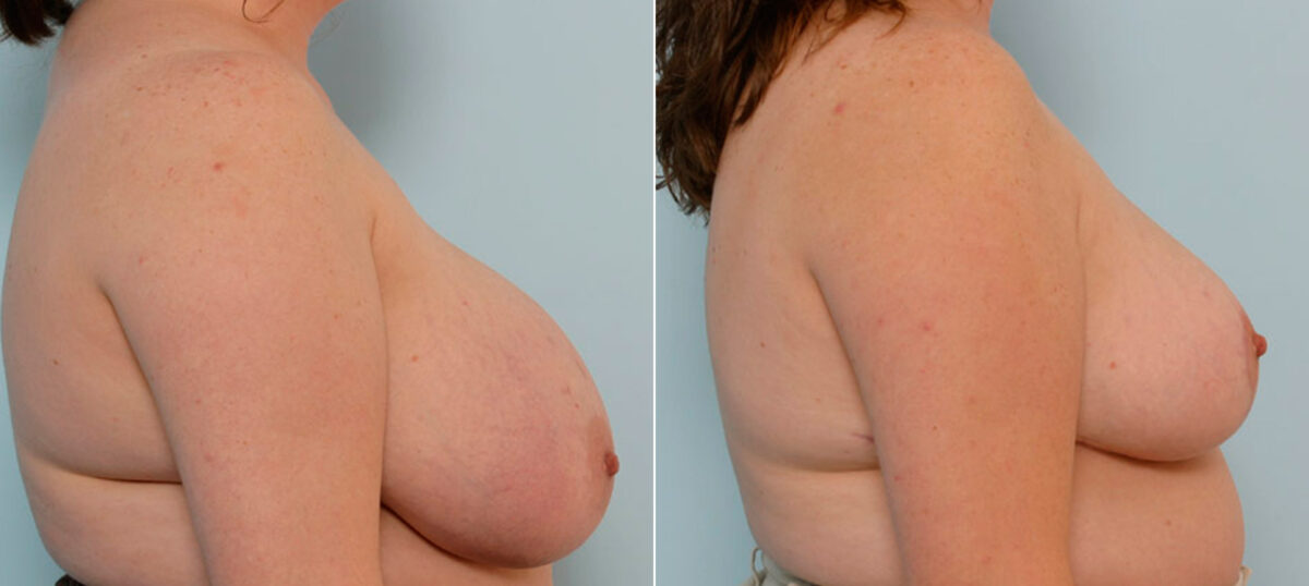 Breast Reduction before and after photos in Houston, TX, Patient 27573