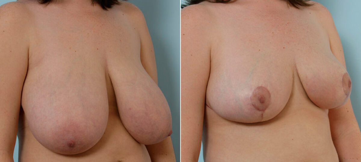 Breast Reduction before and after photos in Houston, TX, Patient 27580