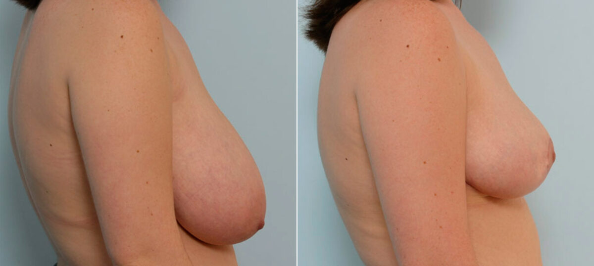 Breast Reduction before and after photos in Houston, TX, Patient 27580