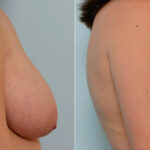 Breast Reduction before and after photos in Houston, TX, Patient 27580