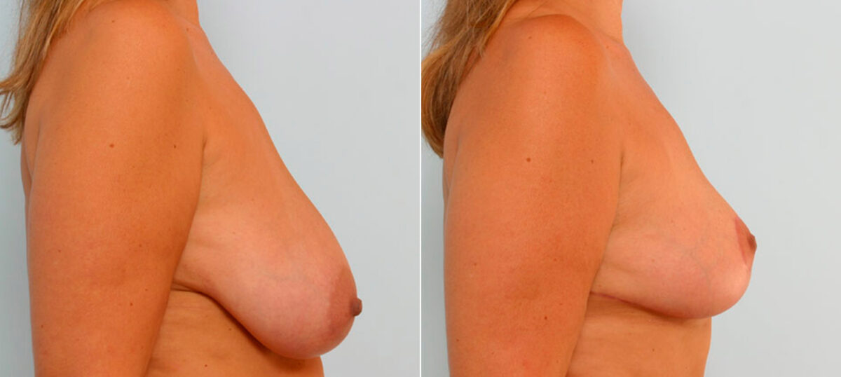 Breast Reduction before and after photos in Houston, TX, Patient 27587