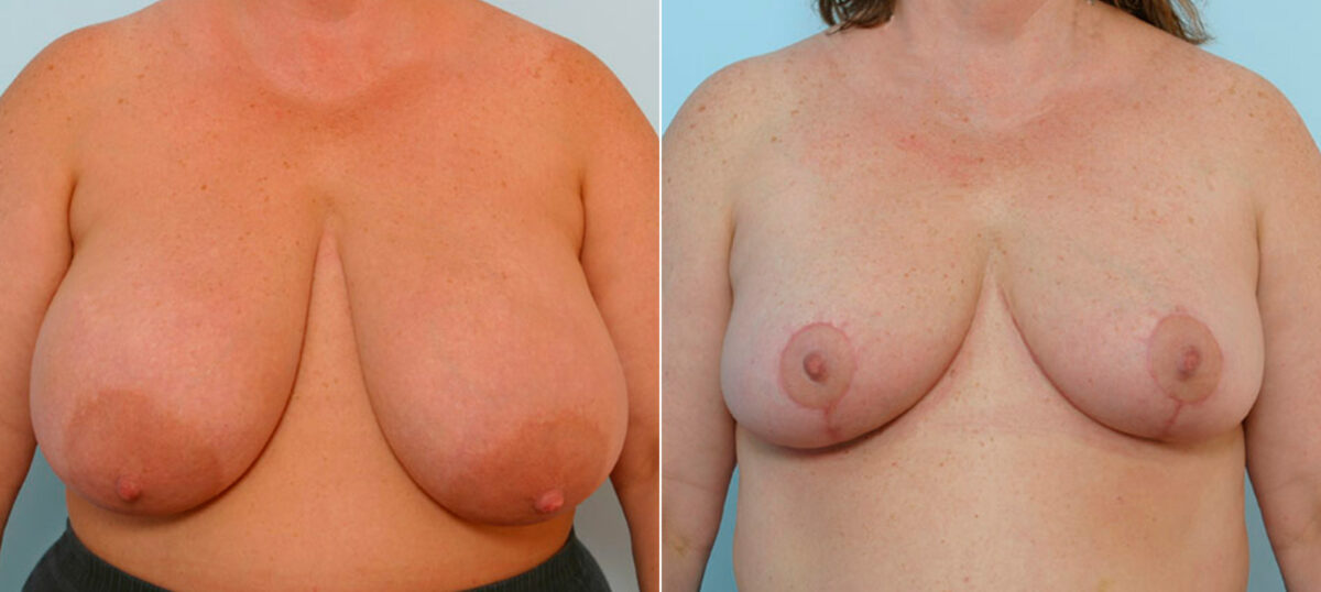 Breast Reduction before and after photos in Houston, TX, Patient 27594