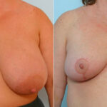Breast Reduction before and after photos in Houston, TX, Patient 27594