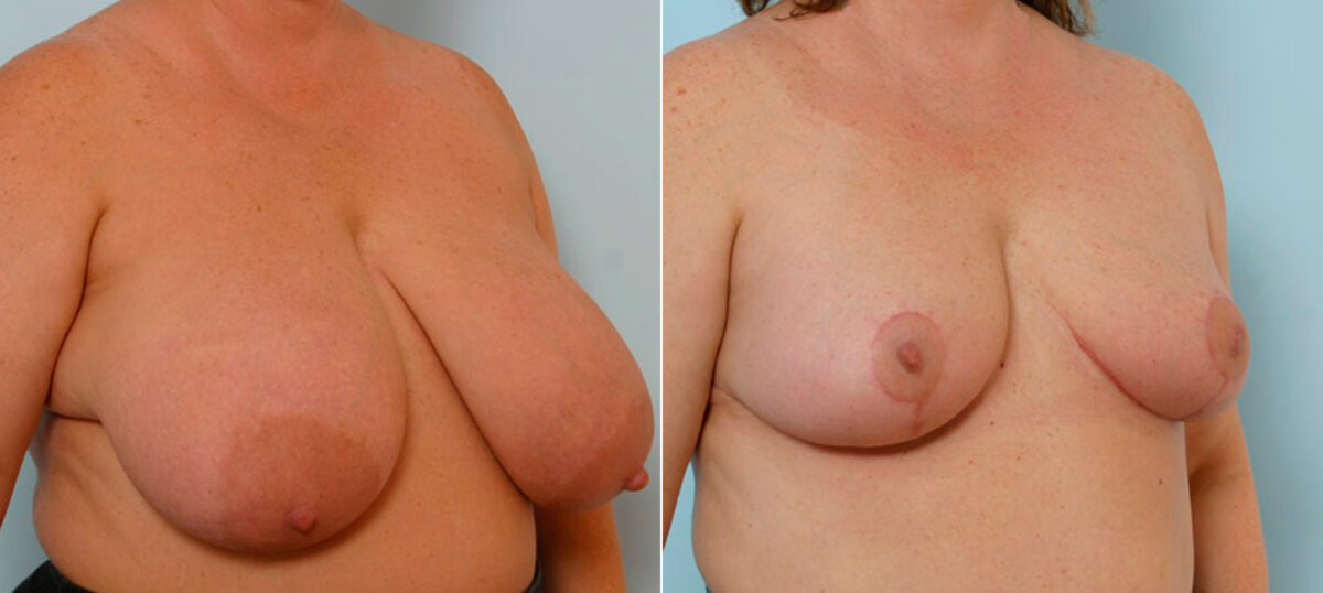 Breast Reduction before and after photos in Houston, TX, Patient 27594