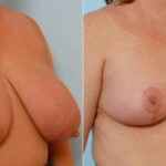 Breast Reduction before and after photos in Houston, TX, Patient 27594