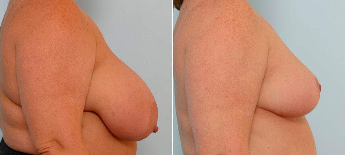 Breast Reduction before and after photos in Houston, TX, Patient 27594