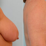 Breast Reduction before and after photos in Houston, TX, Patient 27594