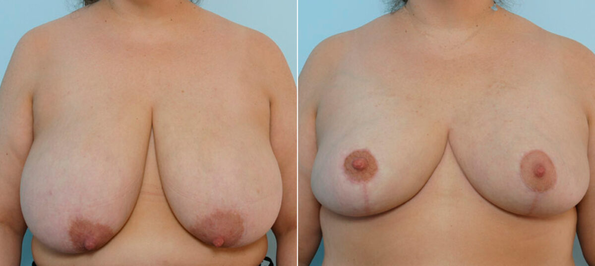 Breast Reduction before and after photos in Houston, TX, Patient 27601