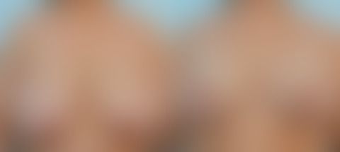 5 Reasons to Consider Breast Reduction Surgery, before and after photos Breast Reduction before and after photos in Houston, TX, Patient 27601