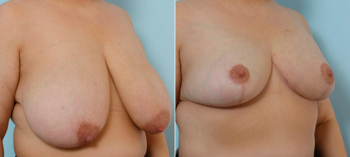 Breast Reduction before and after photos in Houston, TX, Patient 27601