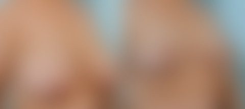 5 Reasons to Consider Breast Reduction Surgery, before and after photos Breast Reduction before and after photos in Houston, TX, Patient 27601