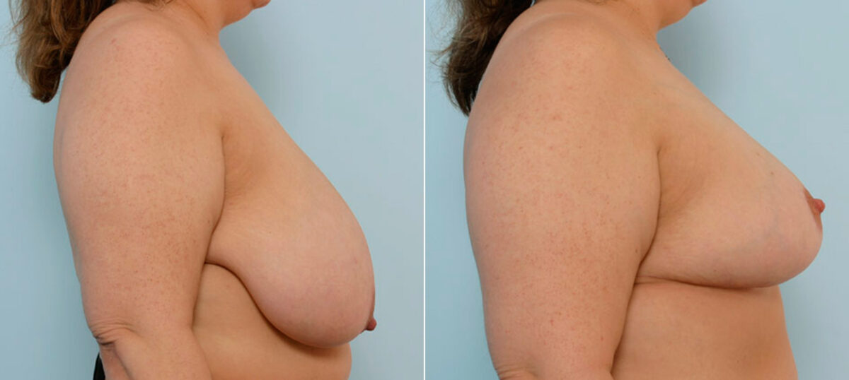 Breast Reduction before and after photos in Houston, TX, Patient 27601