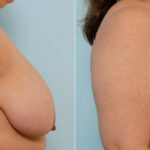 Breast Reduction before and after photos in Houston, TX, Patient 27601