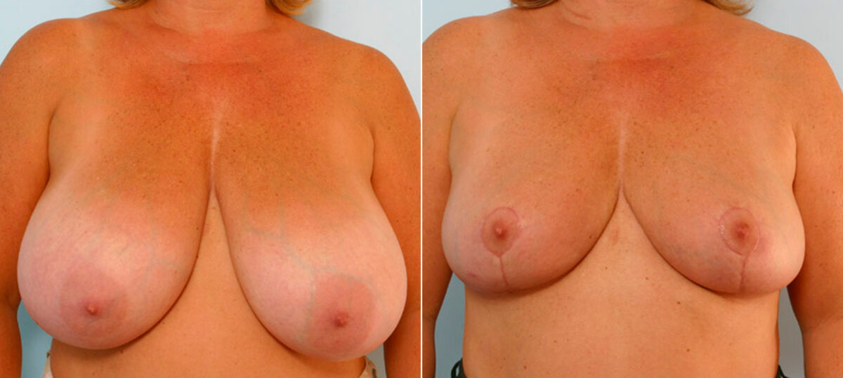 Breast Reduction before and after photos in Houston, TX, Patient 27608