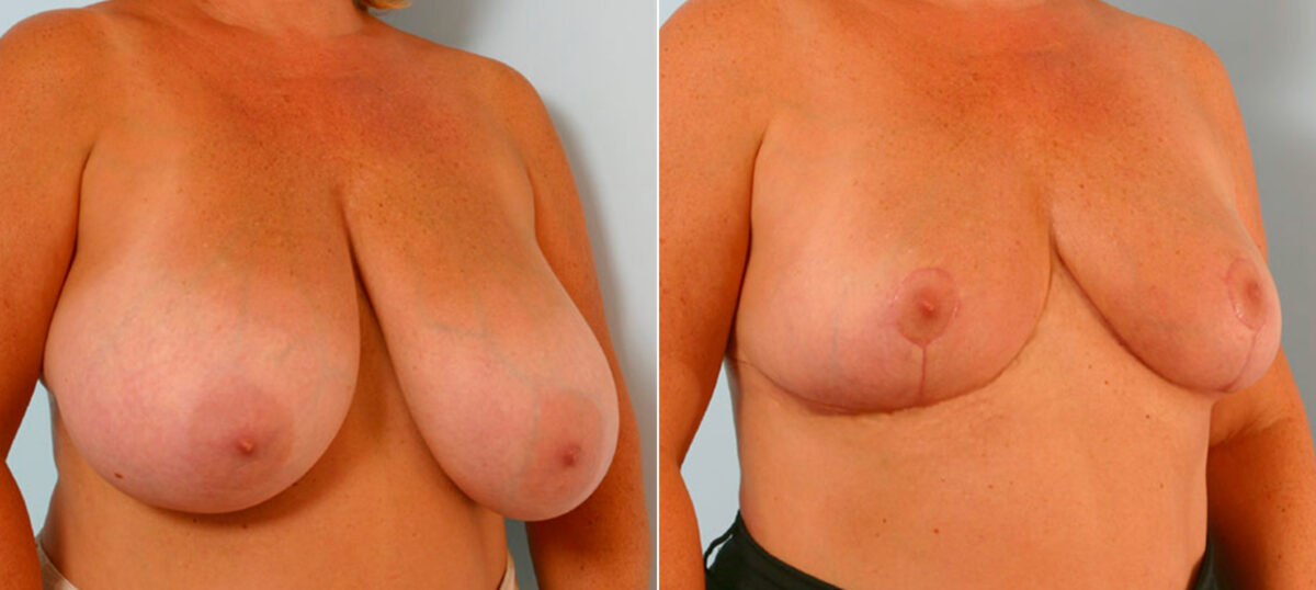 Breast Reduction before and after photos in Houston, TX, Patient 27608