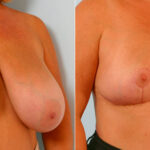 Breast Reduction before and after photos in Houston, TX, Patient 27608