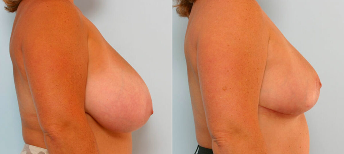 Breast Reduction before and after photos in Houston, TX, Patient 27608