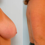 Breast Reduction before and after photos in Houston, TX, Patient 27608