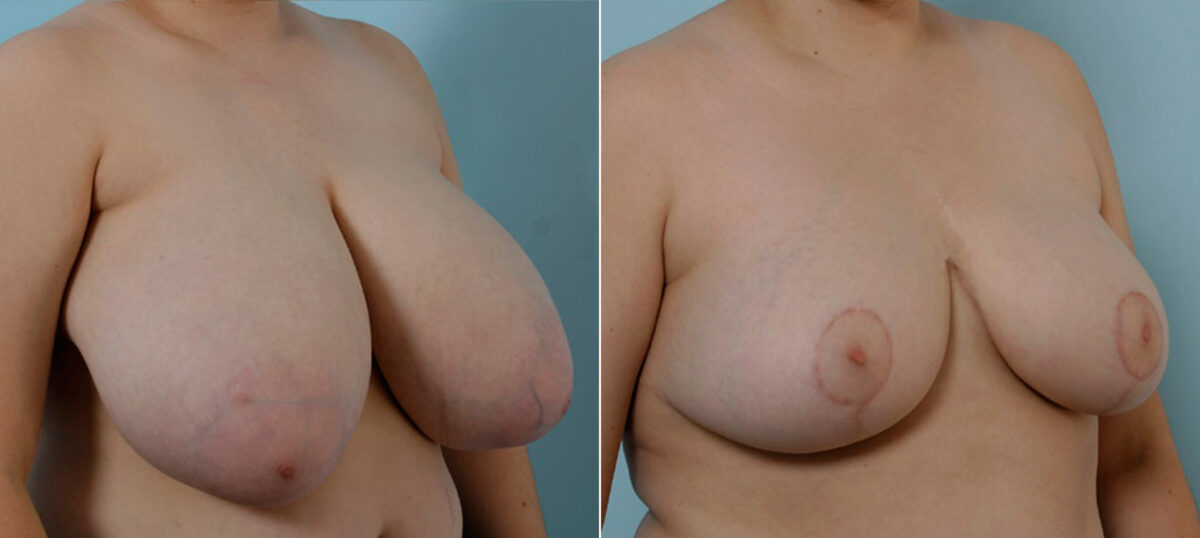 Breast Reduction before and after photos in Houston, TX, Patient 27615
