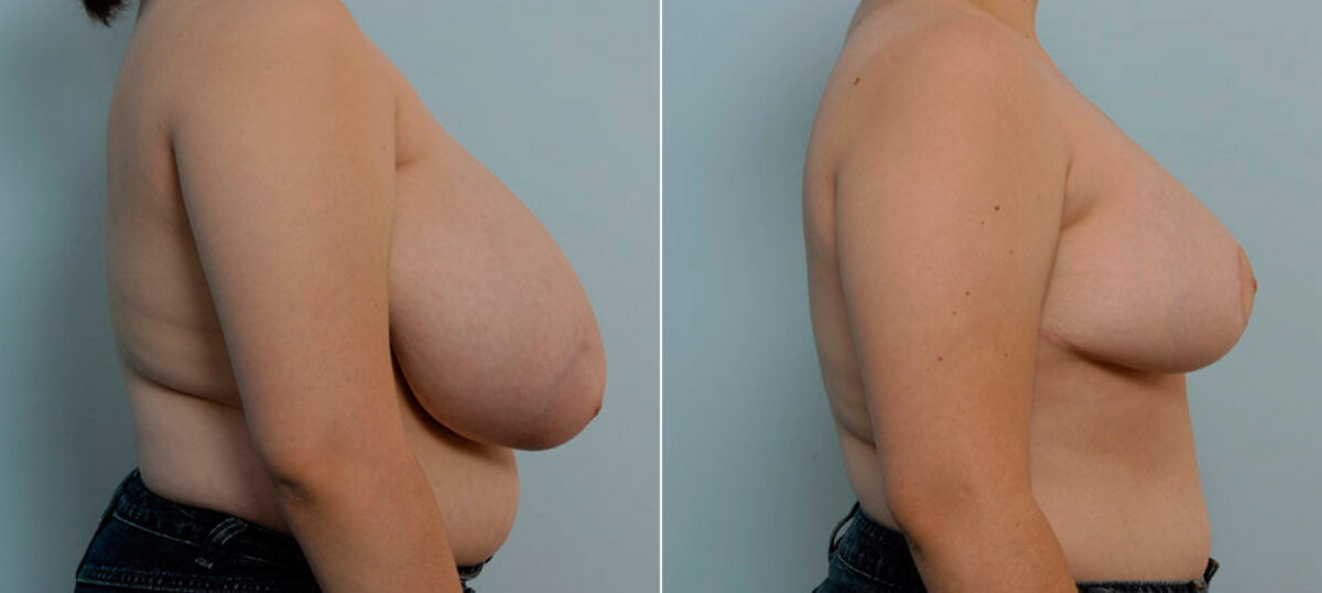 Breast Reduction before and after photos in Houston, TX, Patient 27615