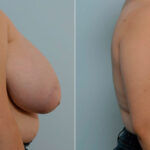 Breast Reduction before and after photos in Houston, TX, Patient 27615