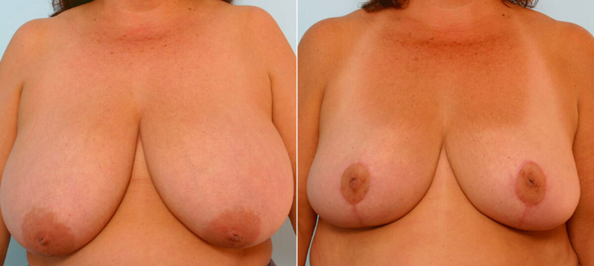 Breast Reduction before and after photos in Houston, TX, Patient 27622