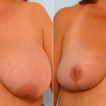 Breast Reduction before and after photos in Houston, TX, Patient 27622