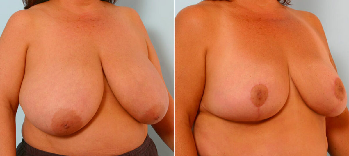 Breast Reduction before and after photos in Houston, TX, Patient 27622