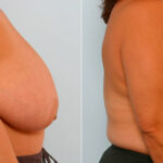 Breast Reduction before and after photos in Houston, TX, Patient 27622