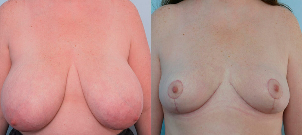 Breast Reduction before and after photos in Houston, TX, Patient 27629