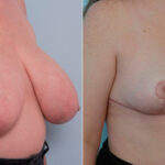 Breast Reduction before and after photos in Houston, TX, Patient 27629