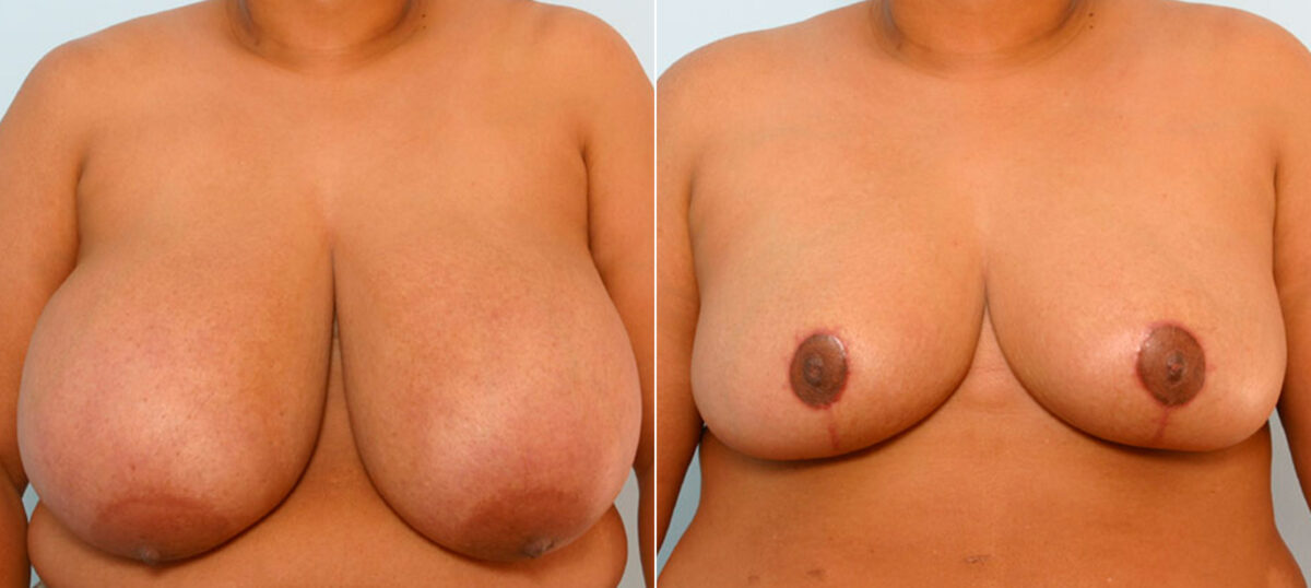 Breast Reduction before and after photos in Houston, TX, Patient 27636
