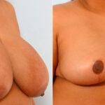Breast Reduction before and after photos in Houston, TX, Patient 27636