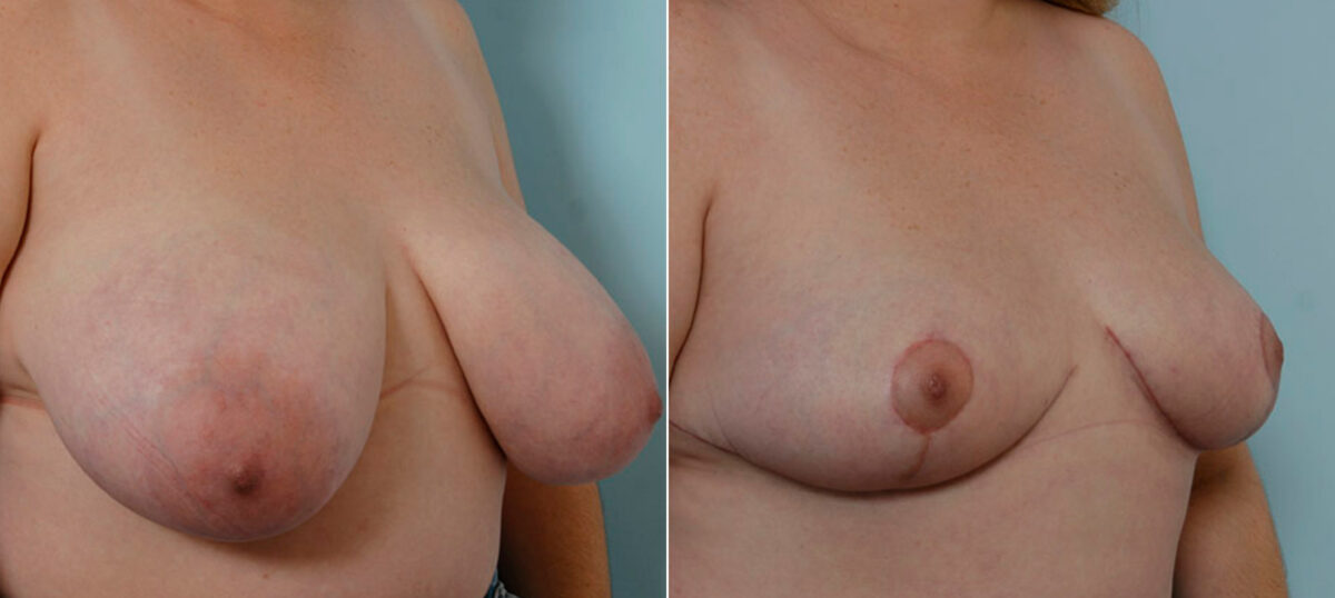 Breast Reduction before and after photos in Houston, TX, Patient 27643