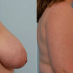 Breast Reduction before and after photos in Houston, TX, Patient 27643