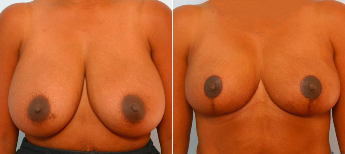 Breast Reduction before and after photos in Houston, TX, Patient 27650