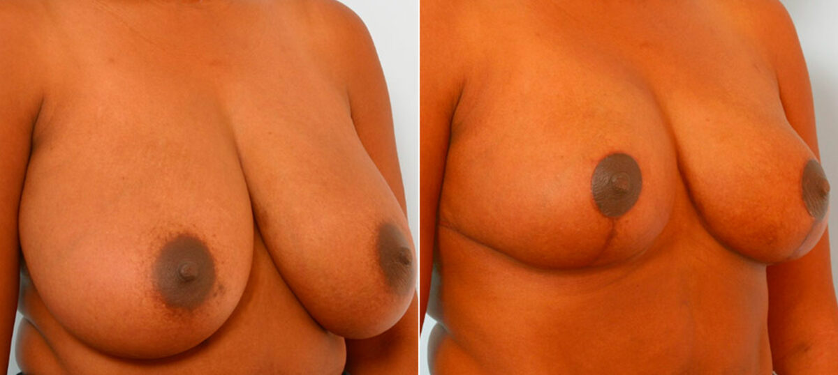 Breast Reduction before and after photos in Houston, TX, Patient 27650