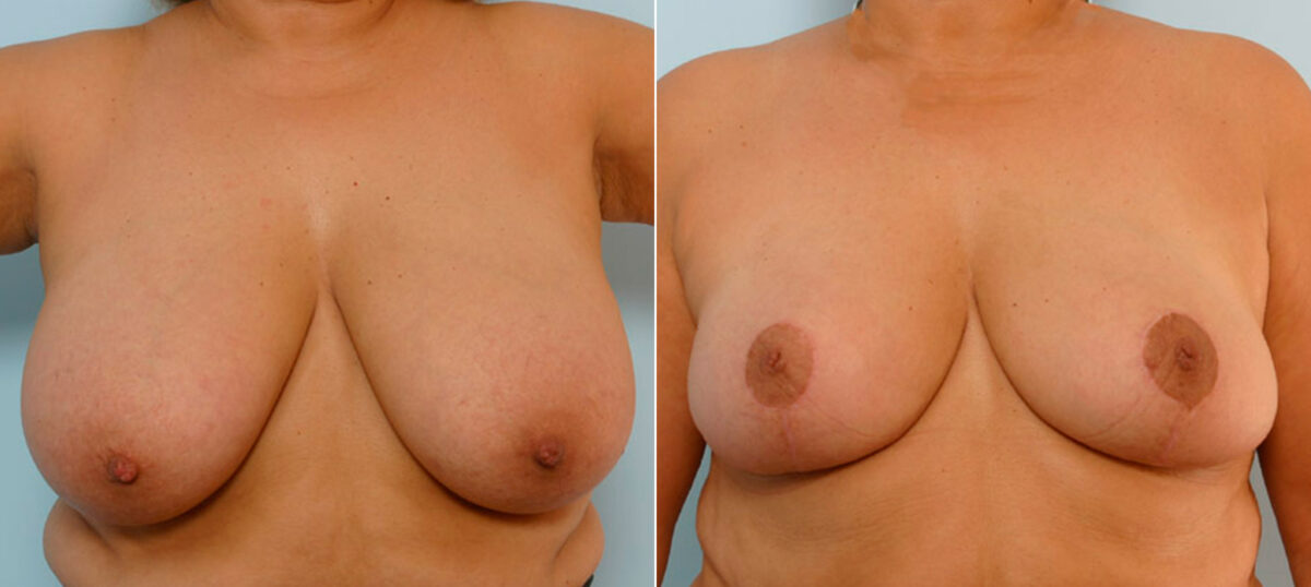 Breast Reduction before and after photos in Houston, TX, Patient 27657