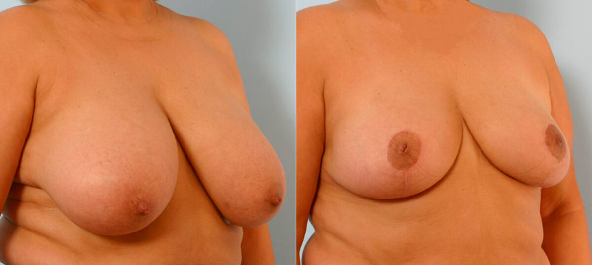 Breast Reduction before and after photos in Houston, TX, Patient 27657