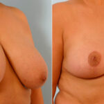 Breast Reduction before and after photos in Houston, TX, Patient 27657