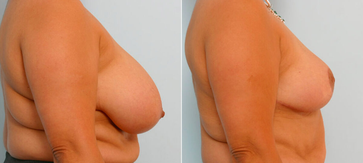 Breast Reduction before and after photos in Houston, TX, Patient 27657