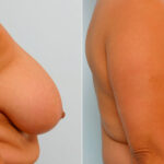 Breast Reduction before and after photos in Houston, TX, Patient 27657