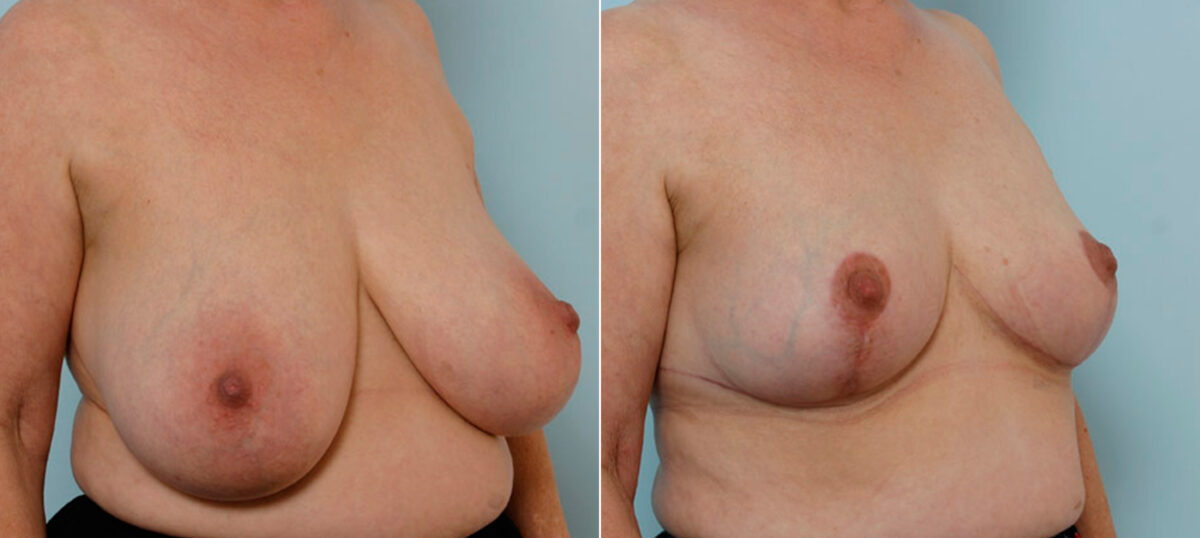 Breast Reduction before and after photos in Houston, TX, Patient 27664