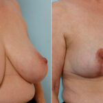 Breast Reduction before and after photos in Houston, TX, Patient 27664