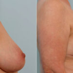 Breast Reduction before and after photos in Houston, TX, Patient 27664