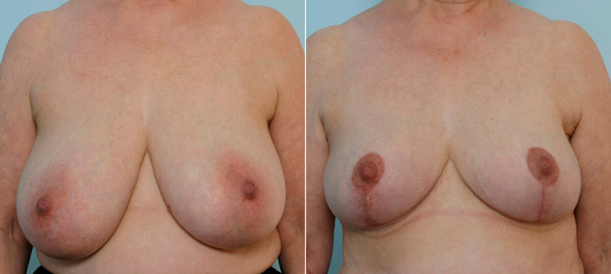 Breast Reduction before and after photos in Houston, TX, Patient 27664