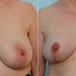 Breast Reduction before and after photos in Houston, TX, Patient 27664