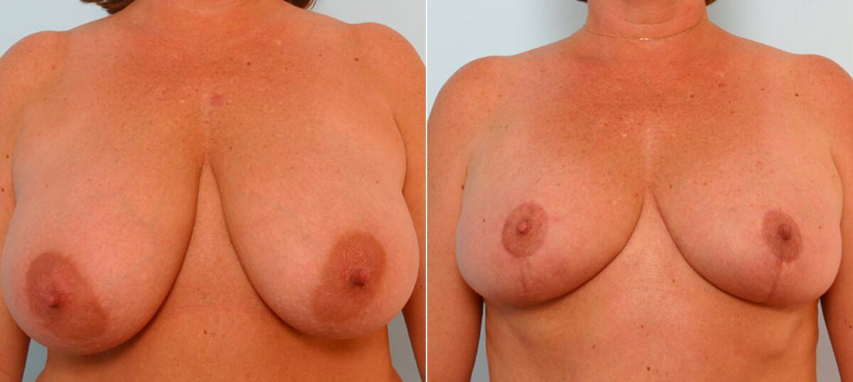 Breast Reduction before and after photos in Houston, TX, Patient 27671
