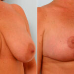 Breast Reduction before and after photos in Houston, TX, Patient 27671